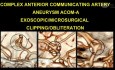 Anévrisme de l'Artère Communicante Antérieure (ACOM) - Excision Microchirurgicale par Clippage/Embolisation