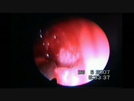 Endoskopia pediatryczna DCR - niedrożność dróg łzowych za woreczkiem - część 1 