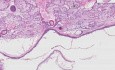 Torbiel skórzasta - Badanie histopatologiczne jajników