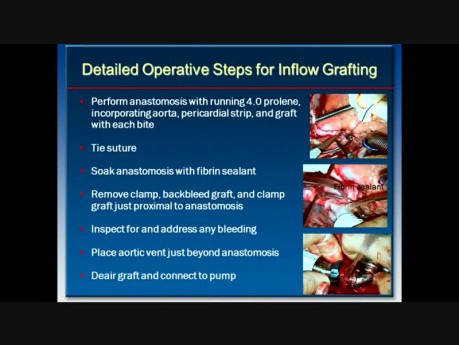 Heartmate II LVAD technika graftu outflow