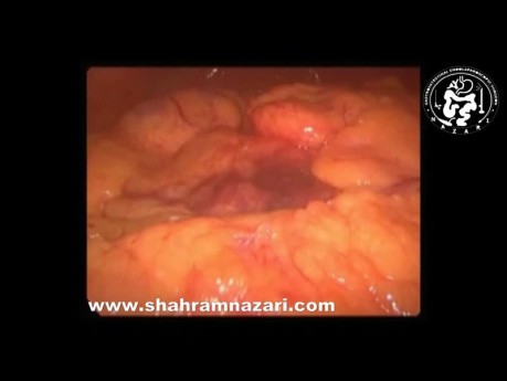 Ostre zapalenie trzustki w laparoskopii