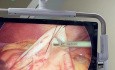 Endoskopowa cholangiopankreatografia wsteczna (ECPW) z użyciem laparoskopii u pacjenta po operacji wyłączenia żołądkowego