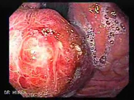 Żylaki żołądka - endoskopowa ablacja klejem cyjanoakrylowym (13 z 18)