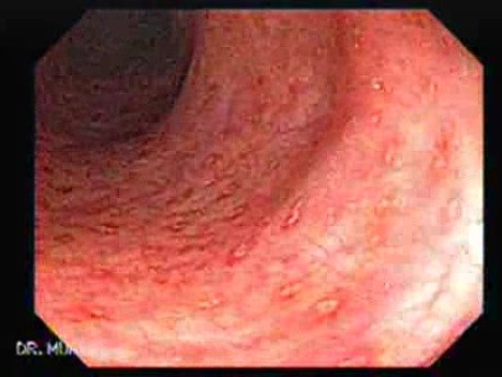 Zapalenie jelita grubego w przebiegu choroby Leśniowskiego-Crohna (3 z 3)