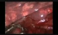 Wideotorakoskopowa lobektomia środkowa z jednego cięcia z powodu malformacji wrodzonej u przytomnego pacjenta.