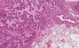 Gruczolakorak pęcherzykowy - histopatologia - płuco