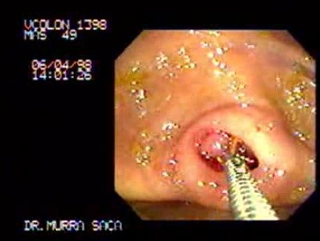 Uszypułowany polip wewnątrz ujścia wyrostka robaczkowego (1 z 2)