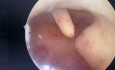 Polip endometrialny w histeroskopii 