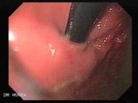 Żołądek w kształcie skórzastej butelki - endoskopia (2 z 9)