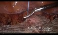 Laparoskopowa pektopeksja w przypadku wypadania układu moczowo-płciowego