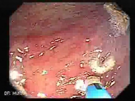 Angiodysplazja jelita grubego (5 z 24)