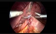 Dwustopniowe laparoskopowe odwrócenie żółciowo-trzustkowe z przełączeniem dwunastnicy