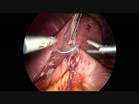 Dwustopniowe laparoskopowe odwrócenie żółciowo-trzustkowe z przełączeniem dwunastnicy