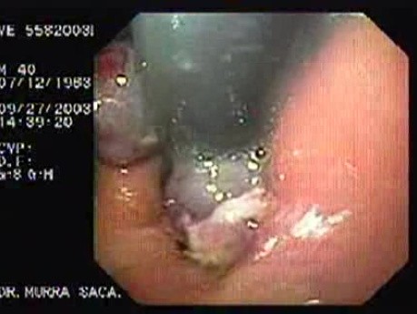Ostre krwawienie z żylaków - obraz wpustu żołądka w inwersji endoskopowej