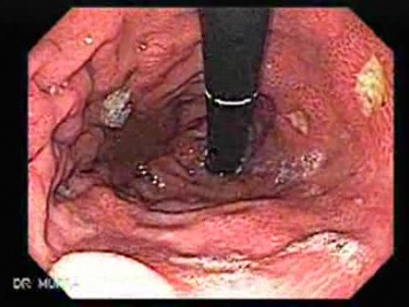 Mnogie wrzody żołądka - endoskopia (1 z 10)