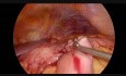 Laparoskopowe ręczne zespolenie żołądkowo-jelitowe i zespolenie Browna z powodu zaawansowanego raka żołądka dystalnej części żołądka