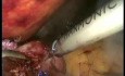 Konwersja laparoskopowej fundoplikacji Nissena do bypassa żołądka sposobem Roux-en-Y