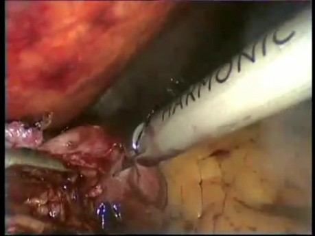 Konwersja laparoskopowej fundoplikacji Nissena do bypassa żołądka sposobem Roux-en-Y