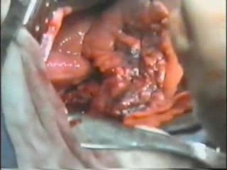 Operacja raka płuca- lobektomia z limfadenektomią