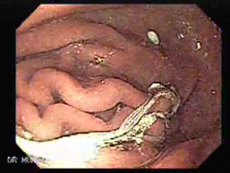 Żylaki żołądka - kształt rozety (17 z 22)