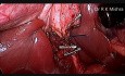Laparoskopowa jednoczasowa cholecystektomia i appendektomia 