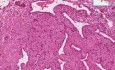 Reakcja doczesnowa - histopatologia macicy