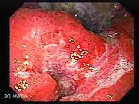 Gruczolakorak żołądka naciekający krzywiznę mniejszą  (2 z 3)