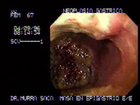 Duży gruczolakorak żołądka - endoskopia