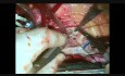 Centralny szew adaptacyjny ( szew Parka) z powodu niedomykalności zastawki aortalnej