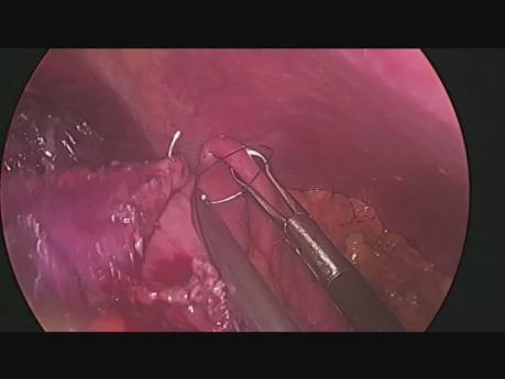 Mini-gastric bypass po rękawowej resekcji żołądka 