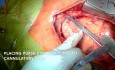 Wymiana zastawki aorty i zastawki mitralnej z dostępu przez sternotomię