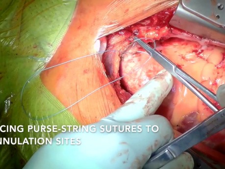 Wymiana zastawki aorty i zastawki mitralnej z dostępu przez sternotomię
