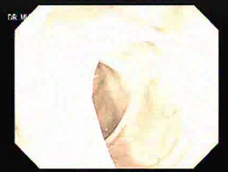 Obrazowanie wąską wiązką (NBI) (1 z 3)