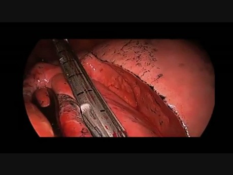 Lobektomia środkowa z powodu raka płuc wykonana metodą Uniportal VATS u pacjenta z zachowaną świadomością (wentylacja spontaniczna)