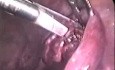Leczenie oszczędzające ciąży ektopowej laparoskopowo