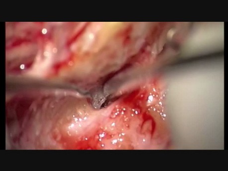 Tympanoplastyka typu second – look ucha lewego 