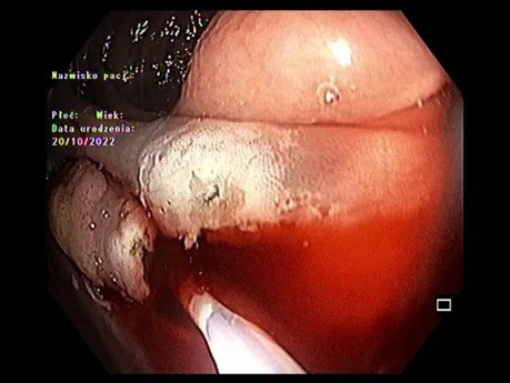 ESD/EMR w okrężnicy wstępującej