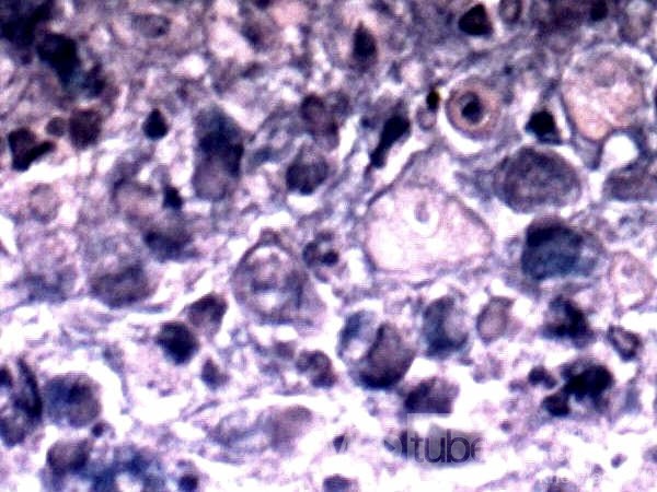 Obraz endoskopowy raka włóknistego żołądka obejmującego dno, trzon i część przedodźwiernikową (6 z 47)