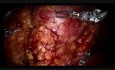 Częściowa resekcja nerki wasyście robota chirurgicznego z selektywnym klemowaniem