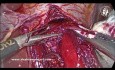 Miotomia Hellera w leczeniu achalazji przełyku