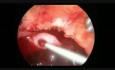 Laparoskopowa salpingektomia z powodu EP z obecnością krwi w jamie otrzewnej