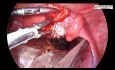 Laparoskopowa cystektomia jajnika z powodu endometriozy
