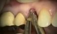 Implantacja górnego prawego zęba przedtrzonowego