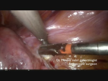 Histerektomia całkowita laparoskopowa