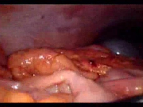 Perforacja okrężnicy z zapaleniem otrzewnej - laparoskopia (29 z 46)