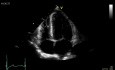 une cardiopathie d'origine hypertensive