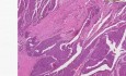 Rak komórek przejściowych  - histopatologia - nerka