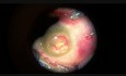 Witrektomia tylna w oku ze zmianami pozapalno krwotocznymi oraz towarzyszącą hypotonią, 3 lata po utracie widzenia i odstąpieniu od leczenia