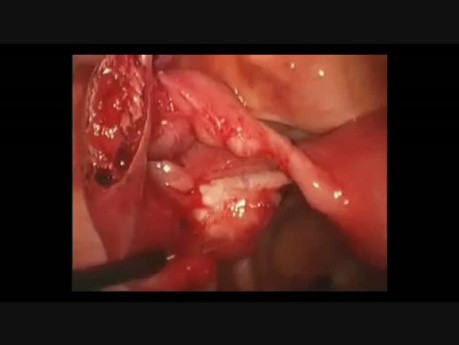 Liniowa salpingotomia- ciąża ektopowa jajowodowa