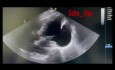 Kardiologia w praktyce - Co widzisz w echokardiografii?